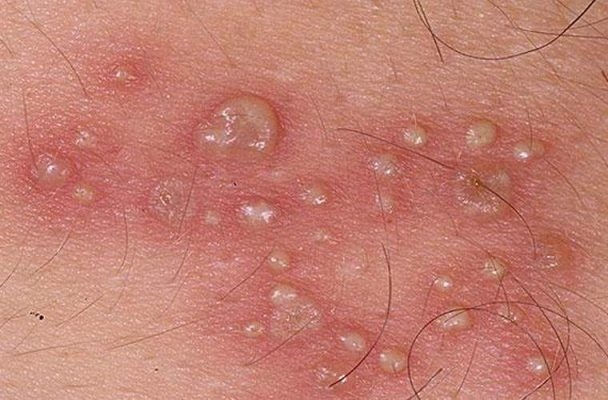 Bệnh Chlamydia