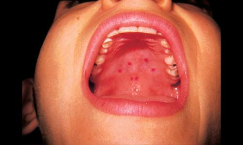 Bệnh lậu vùng họng