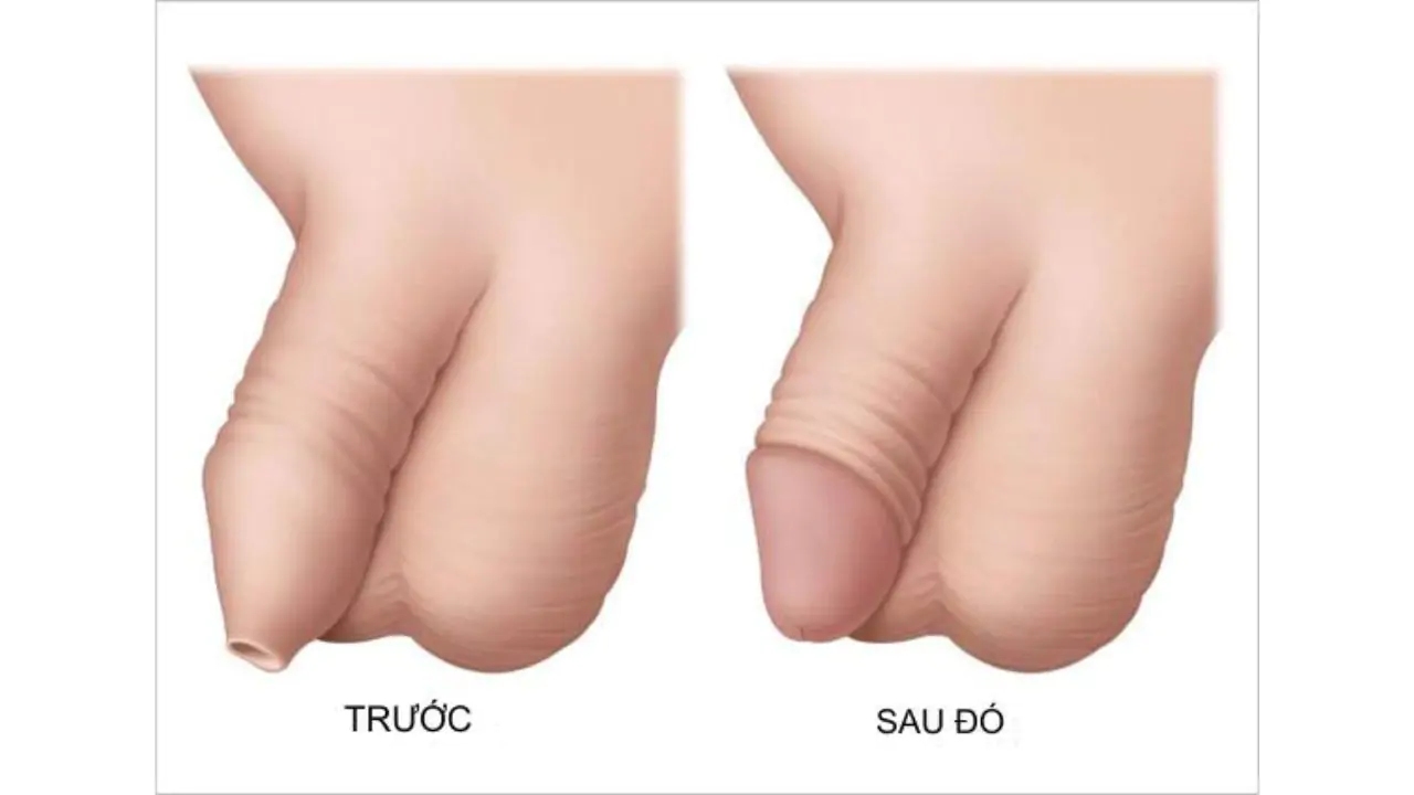Lộn bao quy đầu