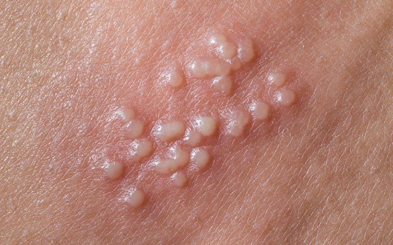 Mụn rộp sinh dục (Herpes)