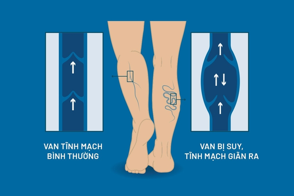 Làm gián đoạn quá trình lưu thông khí huyết toàn thân